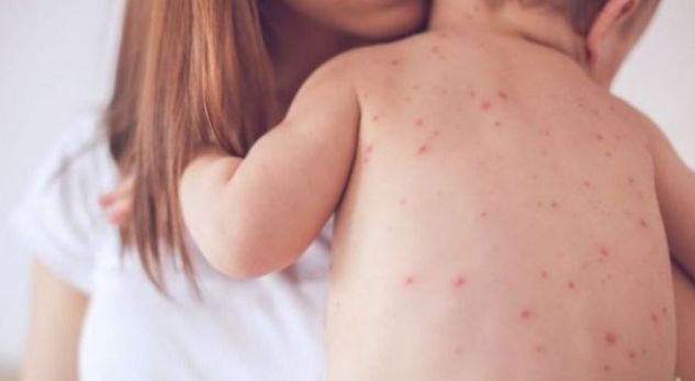 Mjekët japin alarmin, rishfaqet pas 30 vjetësh në Shqipëri sëmundja e rrezikshme