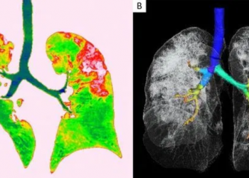 Pamje të rënda/ Shihni skanerin e mushkrive të një viktime nga koronavirusi (FOTO)