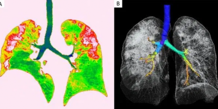 Pamje të rënda/ Shihni skanerin e mushkrive të një viktime nga koronavirusi (FOTO)