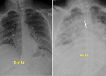 Mjeku publikon mushkëritë e një 28-vjeçari të infektuar me koronavirus