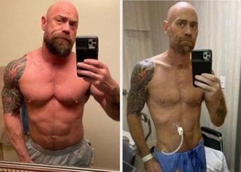 Qëndroi gjashtë javë në intubim nga koronavirusi, infermieri pëson ndryshimin e frikshëm në fizik (FOTO)