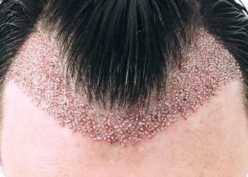 Lajm i mirë/ Mjekësia rigjeneruese mund të zgjidhë një herë e mirë tullacllëkun