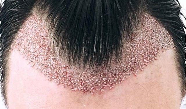 Lajm i mirë/ Mjekësia rigjeneruese mund të zgjidhë një herë e mirë tullacllëkun