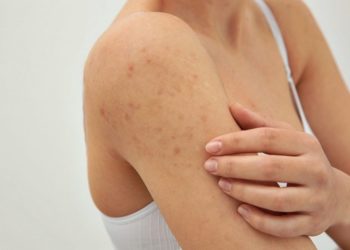 8 këshilla për eleminimin e akneve në trup
