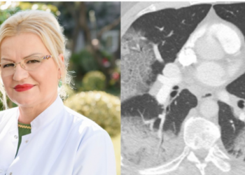 Mjekja publikon foton e mushkrive të një pacienti: Kush jeni ju more palaço ordinerë që s’besoni te Covid 19