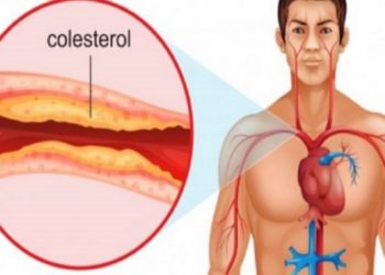 ​Simptomat e kolesterolit të lartë që nuk duhen neglizhuar