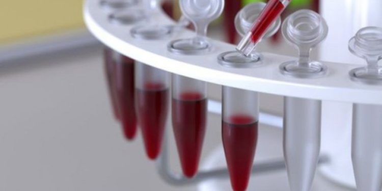 Studimi/ Testi i gjakut që tregon se cili pacient mund t’i mbijetojë virusit COVID-19