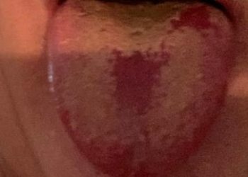 Studimi/ 70% e njerëzve të hospitalizuar nga Covid-19 nuk janë shëruar plotësisht pesë muaj pas daljes