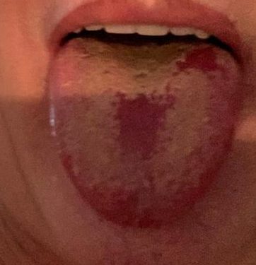 Studimi/ 70% e njerëzve të hospitalizuar nga Covid-19 nuk janë shëruar plotësisht pesë muaj pas daljes