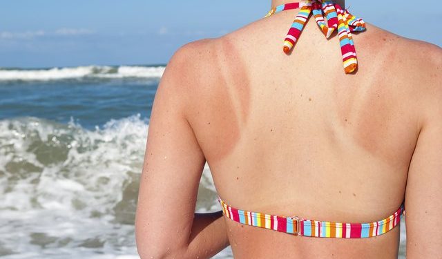 Miell misri për djegien nga dielli/ Si ta realizoni në kushte shtëpie