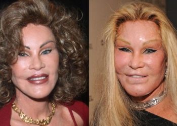 Pse njerëzit nuk i pranojnë ndërhyrjet estetike