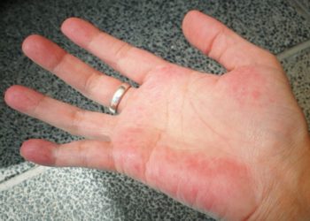 Shikoni pëllëmbën tuaj dhe kontaktoni menjëherë mjekun nëse vëreni këtë ndryshim