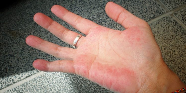 Shikoni pëllëmbën tuaj dhe kontaktoni menjëherë mjekun nëse vëreni këtë ndryshim