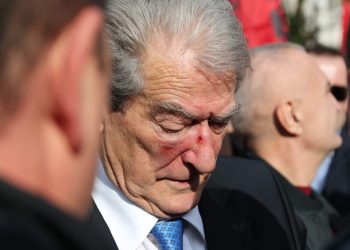 Shenjat e grushtit në fytyrën e Sali Berishës (FOTO)