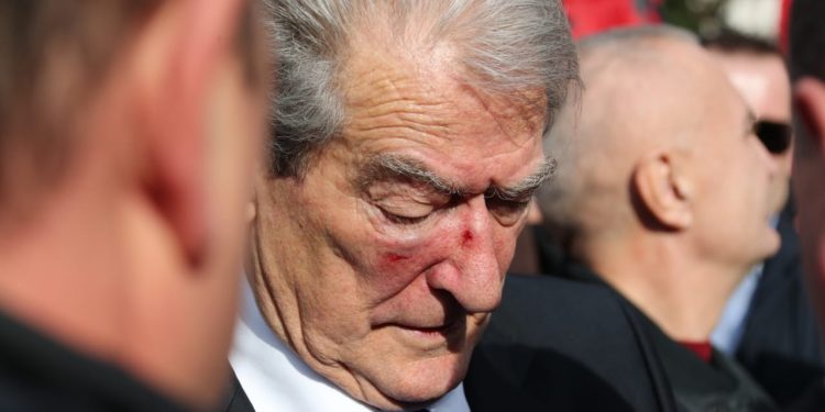 Shenjat e grushtit në fytyrën e Sali Berishës (FOTO)