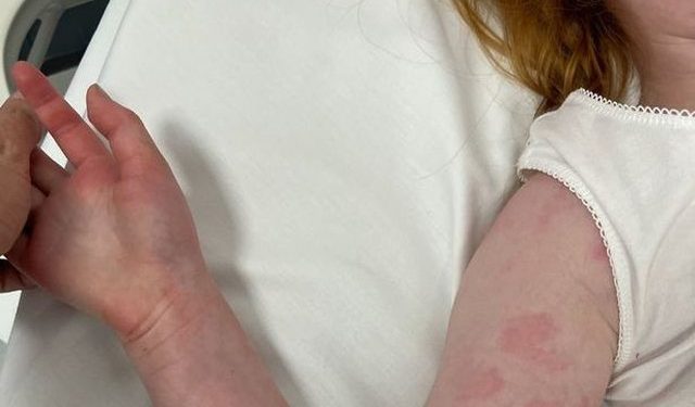 Alarmi në Greqi/ 3 fëmijë humbin jetën nga Streptokoku A, rritet numri i të infektuarve