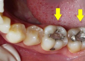Të ndaluara me ligj, si po ju helmojnë “mbushjet e zeza” në dhëmbë!