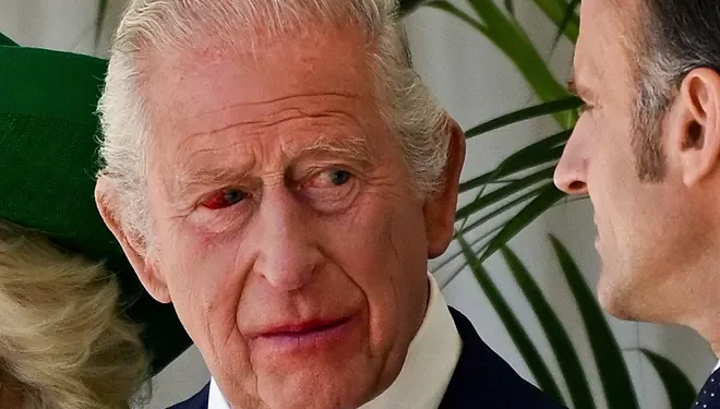 “Frikë nga më e keqja”/ Shëndeti i Mbretit Charles ndez alarmet në pallat
