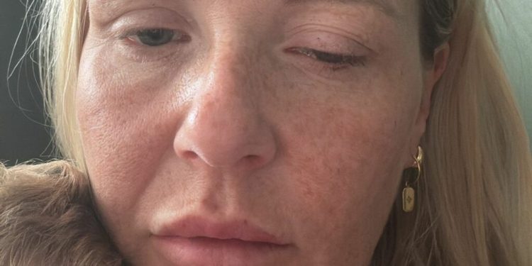 Shpërthim botulizmi në Britani, dhjetëra të prekur nga injeksionet kozmetike ilegale