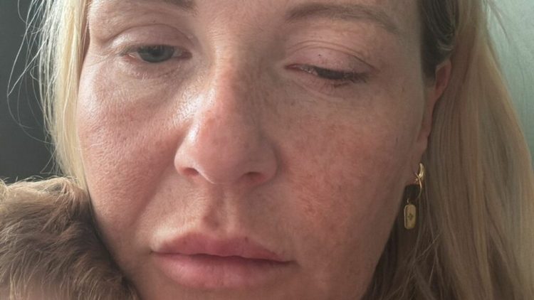 Shpërthim botulizmi në Britani, dhjetëra të prekur nga injeksionet kozmetike ilegale