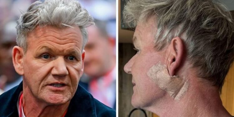 Gordon Ramsay kalon nëpër një operacion për kancerin e lëkurës: Mesazhi i tij për fansat