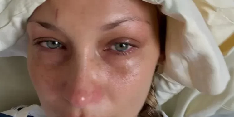 Bella Hadid shfaqet për herë të parë në publik pas zbulimit të betejës me Lyme disease