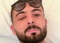 U plagos në sy gjatë protestës, Erjon Vishkulli poston foton pas operacionit në Itali