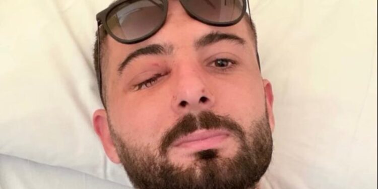 U plagos në sy gjatë protestës, Erjon Vishkulli poston foton pas operacionit në Itali